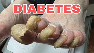 VERY THICK AND LONG DIABETIC TOE NAILS