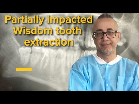 Partially impacted Wisdom Tooth Extraction