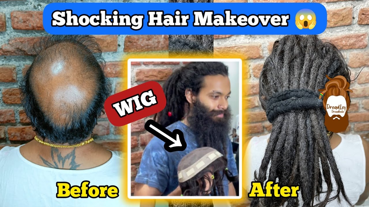 Wig Installation on Bald Hair Patch Mumbai Wigs for Sale Dreadlocks