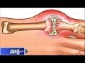 Nguy hiểm bệnh Gout nhầm sang xương khớp | VTC