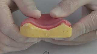 Denture Relining (Rebase)