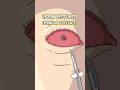 Vision Restored Using a Tooth!?