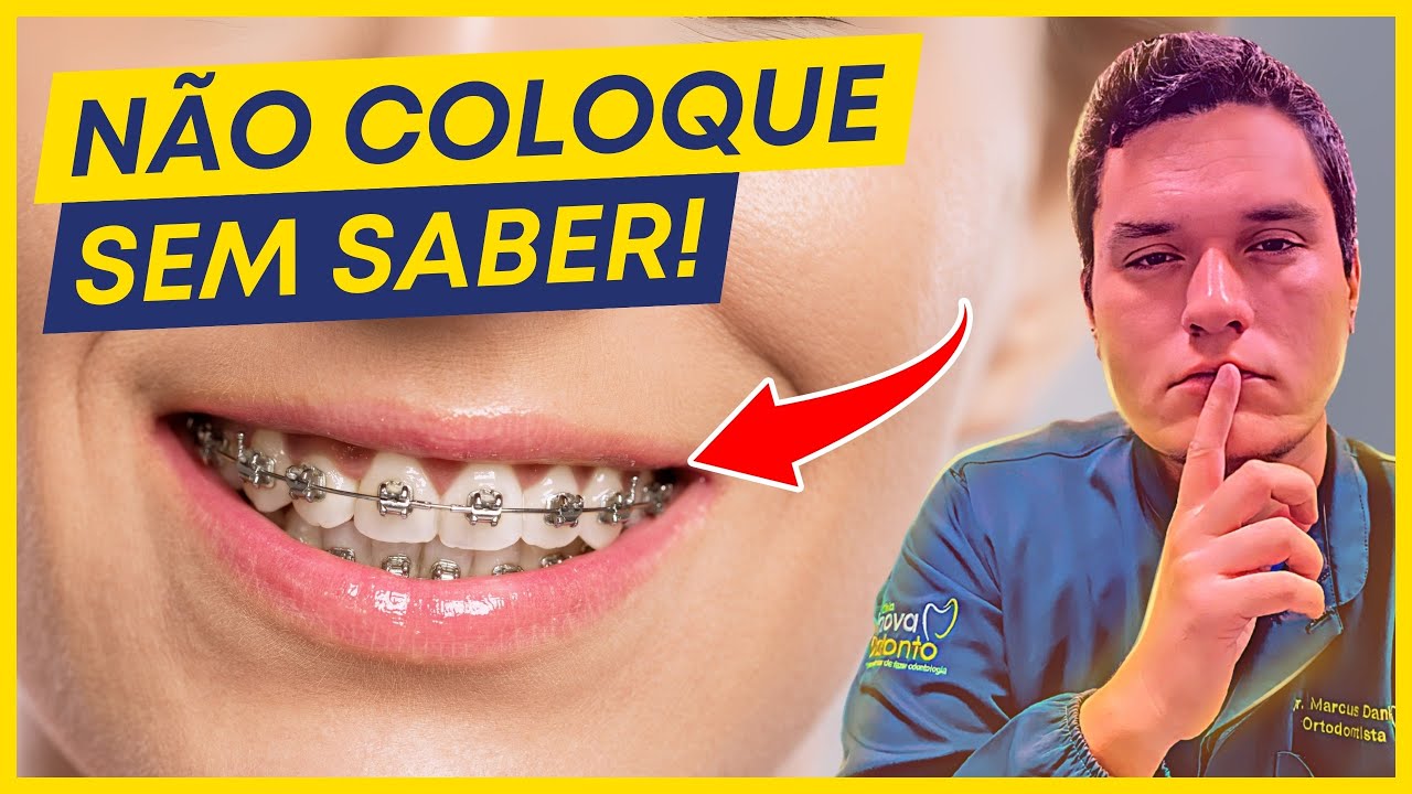 10 Coisas para saber ANTES de colocar APARELHO ORTODÔNTICO!
