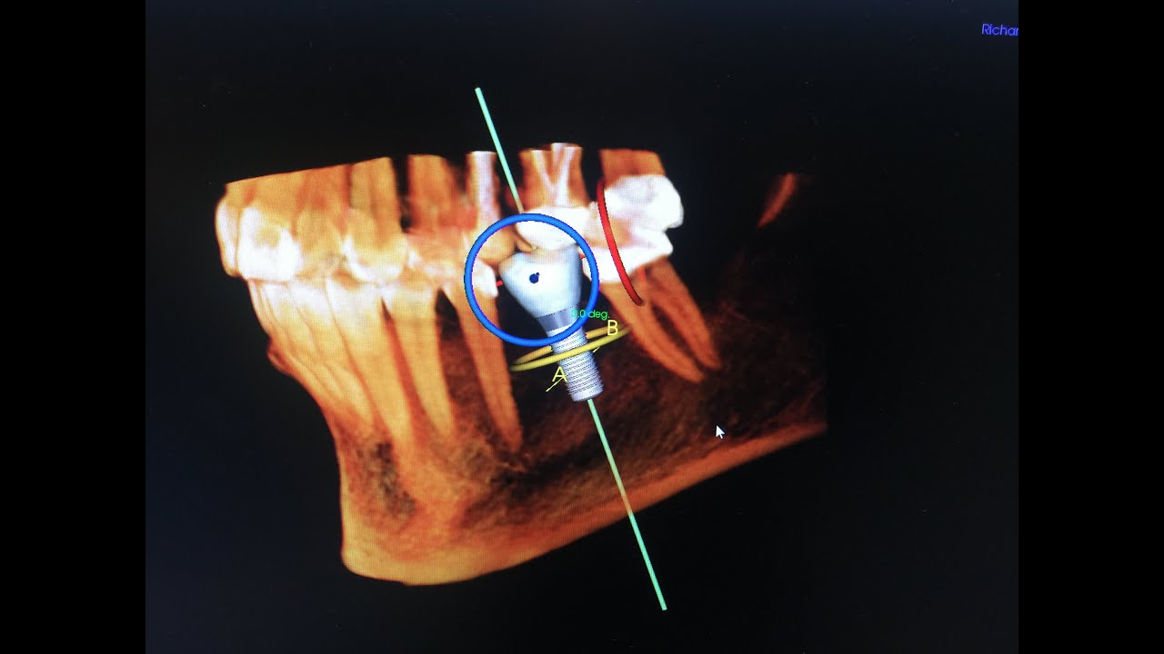 Standard Dental Implant Surgery YouTube