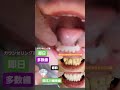 即日多数歯今井です💎連日カウンセリング後にその日即日セラミックスタートする方に恵まれております。こちらのモニター様は前歯の歯並びや虫歯、過去に治療した部分のやり残しなど多岐に渡っていました