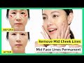 Lifting & Remove Mid Cheek Lines, Mid Face Lines Permanent without Filler |