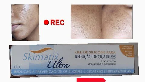 Para que serve a pomada Skimatix ultra?