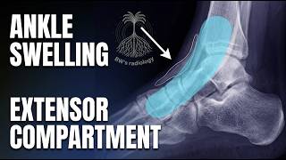 Ankle X-ray: Approach to Extensor Compartment Soft Tissue Swelling screenshot 5