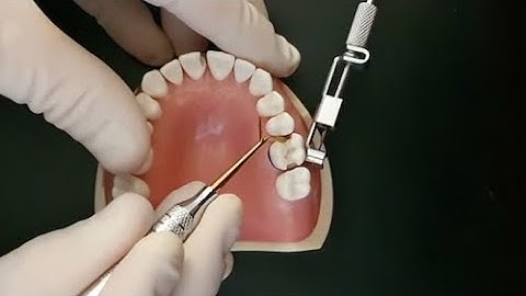 La bande de remontée de marge Margin Elevation Band de Garrison