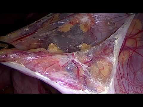 Video: Unicornuate Uterus: Mõju Rasedusele, Raseduse Katkemisele Ja Muule