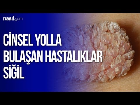 Cinsel Yolla Bulaşan Hastalıklar Siğil