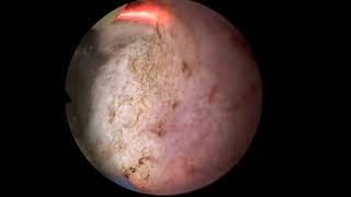 Transurethral Resection Of Prostatic Abscess