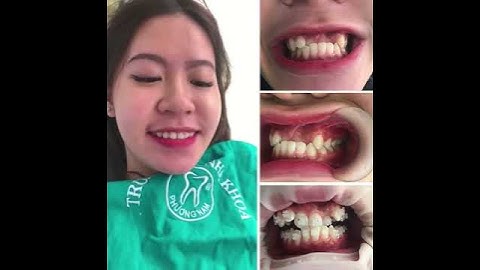 8 tháng niềng răng - hết khớp cắn ngược