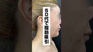 50代で脂肪吸引は危険⁉️⚠️ #blincclinic #整形 #美容整形 #脂肪吸引 #クォンタム
