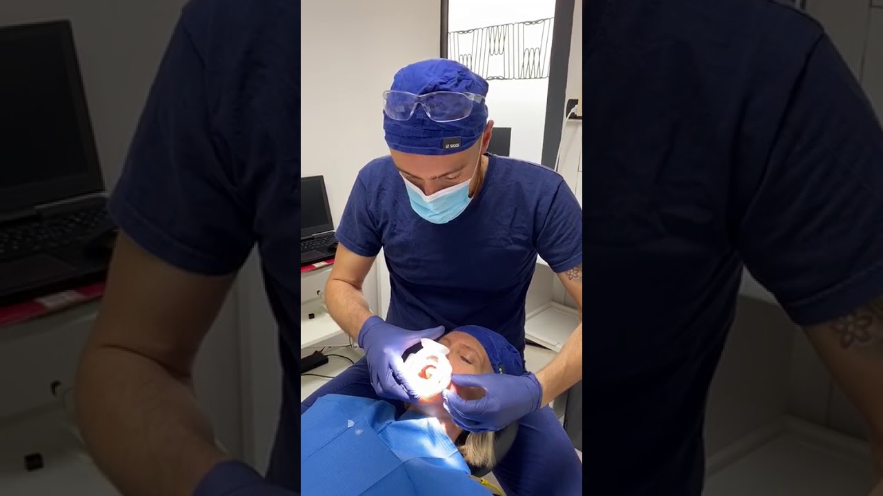 Montaggio Aerosolvex  con  OptraGate