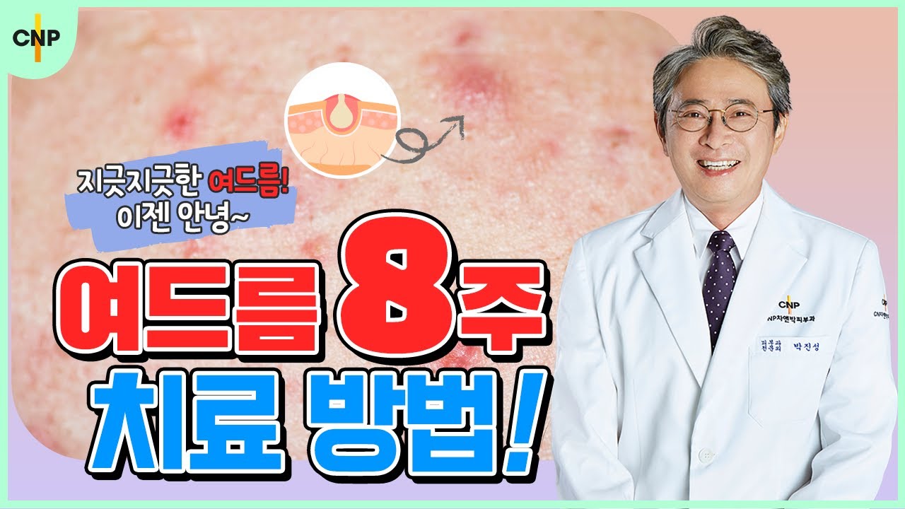 지긋지긋한 여드름 고민을 날려줄 여드름 8주 치료방법!
