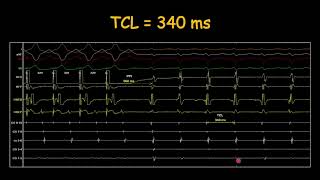 How to assess entrainment response in AVNRT?