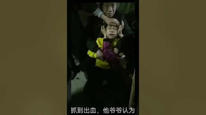 小孩被狗咬了狂犬病发作 - 天天要闻
