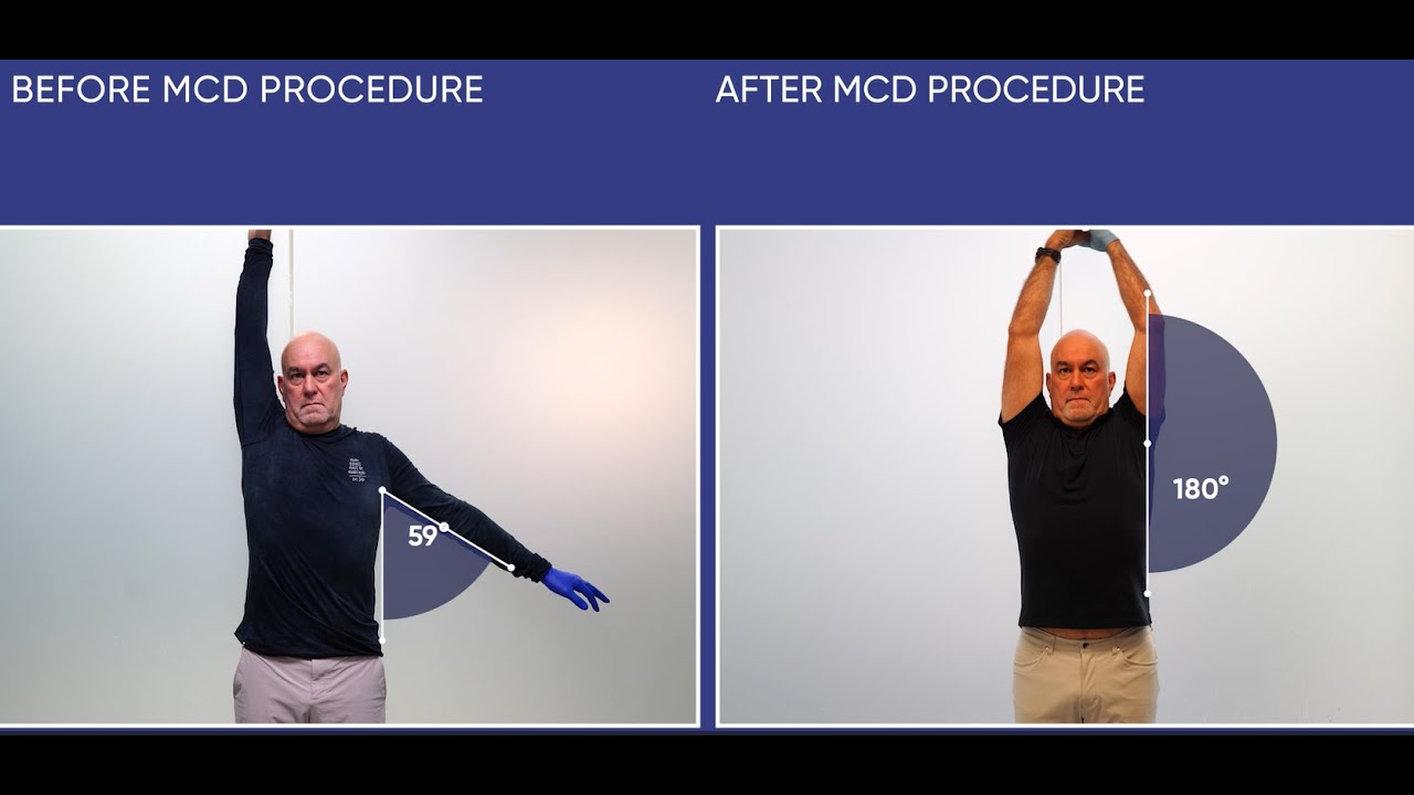 Back on the Job: Sales Rep Beats Frozen Shoulder in 2 Days