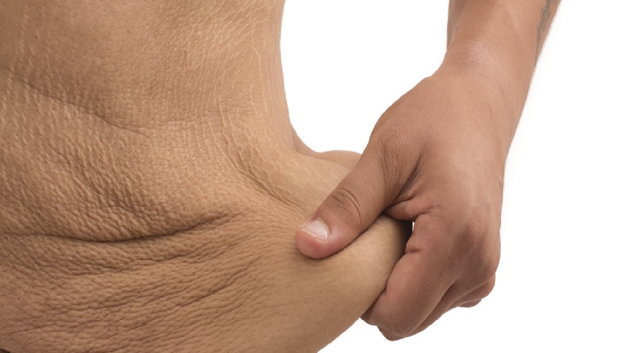 how to get rid of loose skin after weight loss easy - YouTube