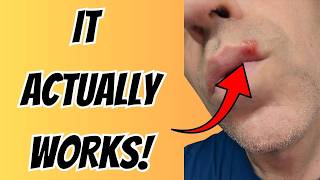 How I Cleared Up My Cold Sore Fast Using These 2 Products
