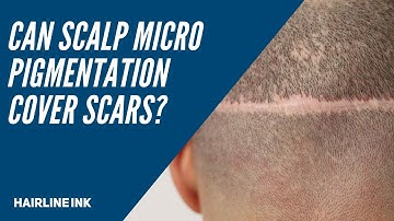 Can Scalp Micropigmentation Cover Scars?