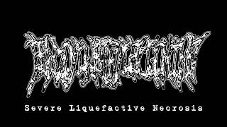 Benzoylmethylecgonine - Severe Liquefactive Necrosis