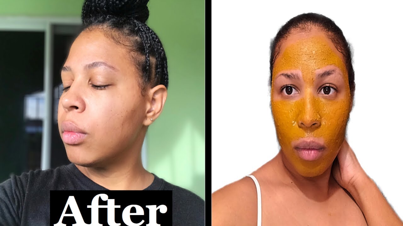 I TRIED DIY TURMERIC FACE MASK FOR 5 DAYS!!! See my results!! Diy 5