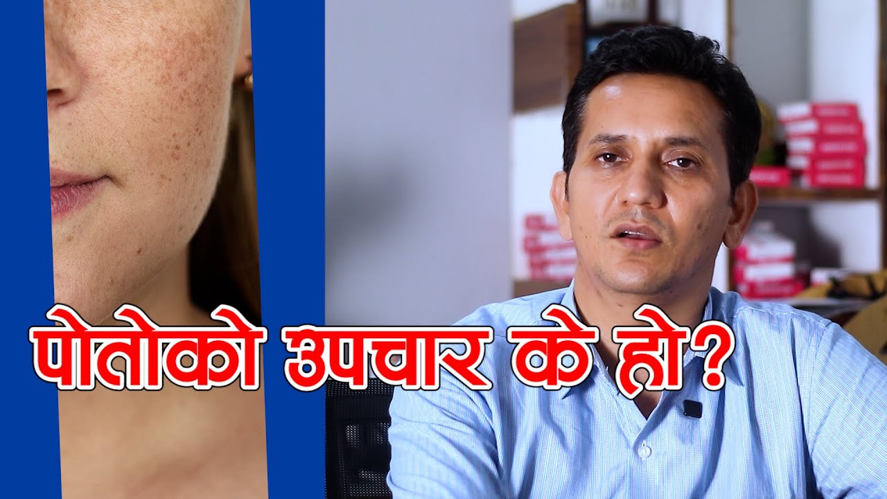 चाँया पोतो भएकाले गर्न नहुने १ गल्ती । पोतोको सहि उपचार ।  Dr. Achyut Pokharel || NIKO NEPAL
