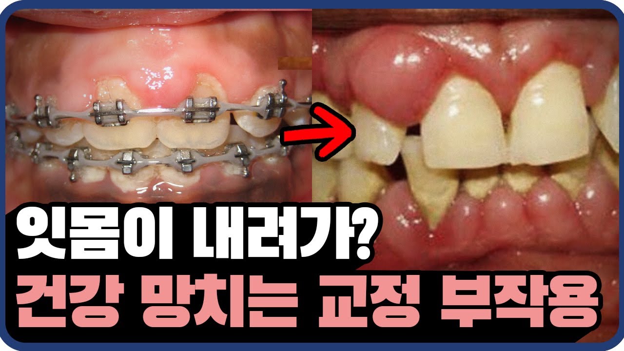 ()나한테도 교정 부작용..? ㅣ 강남 치과 원장님이 알려드립니다!