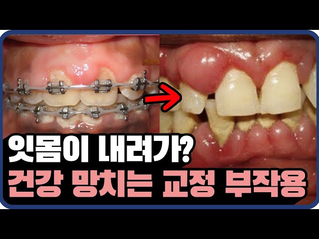 ()나한테도 교정 부작용..? ㅣ 강남 치과 원장님이 알려드립니다!