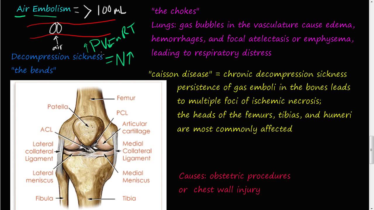 Caisson Disease Pathophysiology Get Images