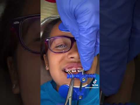 Video: Vai zobārstiem ir jāvalkā sejas aizsargi?