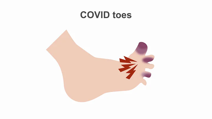 Appreciating potential complications of COVID-19 - DayDayNews