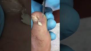 Even I Was Shocked After the First Cut!#IngrownToenail #FootCare #SatisfyingRemoval