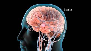 Stroke What Happens Inside Your Brain? | 3D Medical Animation Breakdown