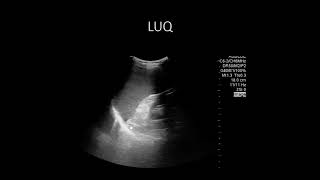POCUS Cases 9: Abdominal Free Fluid