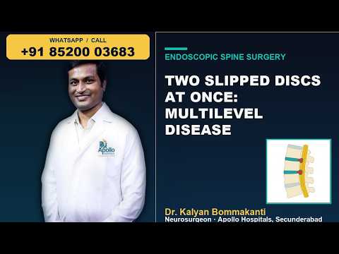 Two Slipped Discs at Once: Multilevel Disease - Best Endoscopic Spine Surgeon in Hyderabad