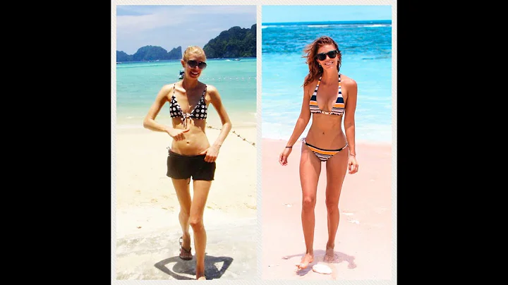 MY STORY // Overcoming Anorexia + Binge Eating Dis...