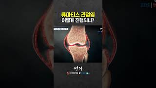 류마티스 관절염 진행 단계