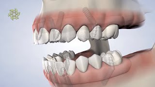 Post-Op Instructions: Diem Full-Arch Restoration at Beacon Oral & Maxillofacial Surgeons