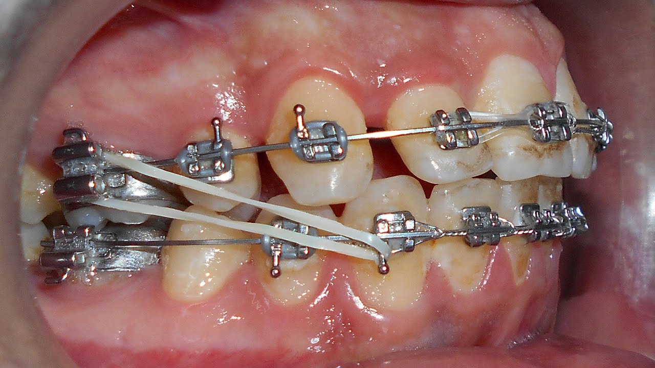 السيطرة على العلاقات الإطباقية من خلال مطاط الصنف الثالث في حالات القلع على الفك العلوي دون السفلي