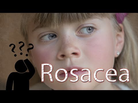  Effective Home Remedies For ROSACEA   How to Get Rid of Rosacea Naturally