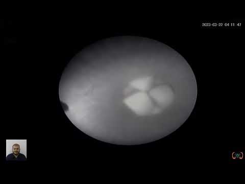 استخراج مجموعه حصوات صغيره من الكلى دكتور يسرى ابو على