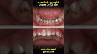 Black Teeth In Kids? The Truth Will Shock You In Malayalam Dr.aswin