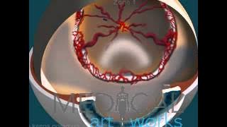 3D Medical Animation | 5 Stages ROP