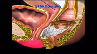 STARR SURGERY FOR ODS ANIMATED