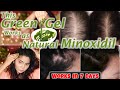 Natural Minoxidil Gel-7 दिन में दिखेगा फ़र्क़   लौटाये खोए हुए बाल For Patchy HAIR LOSS &Triple growth