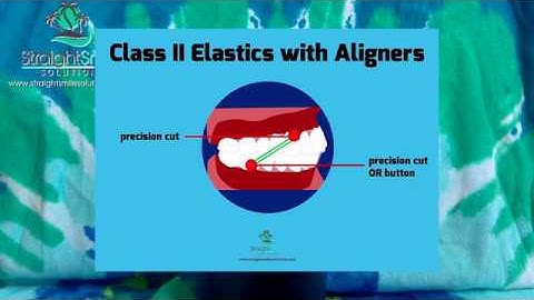 Class II 2,  III 3 elastics clear aligners https://www.straightsmilesolutions.com/