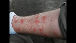 Famous Medical Index - Summertime Rashes Wealth